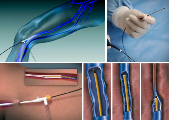 Endovenous Radio Frequency Ablation