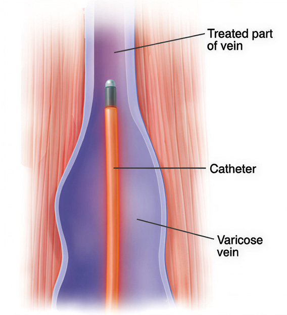 RFA Treatment to Remove Varicose Veins
